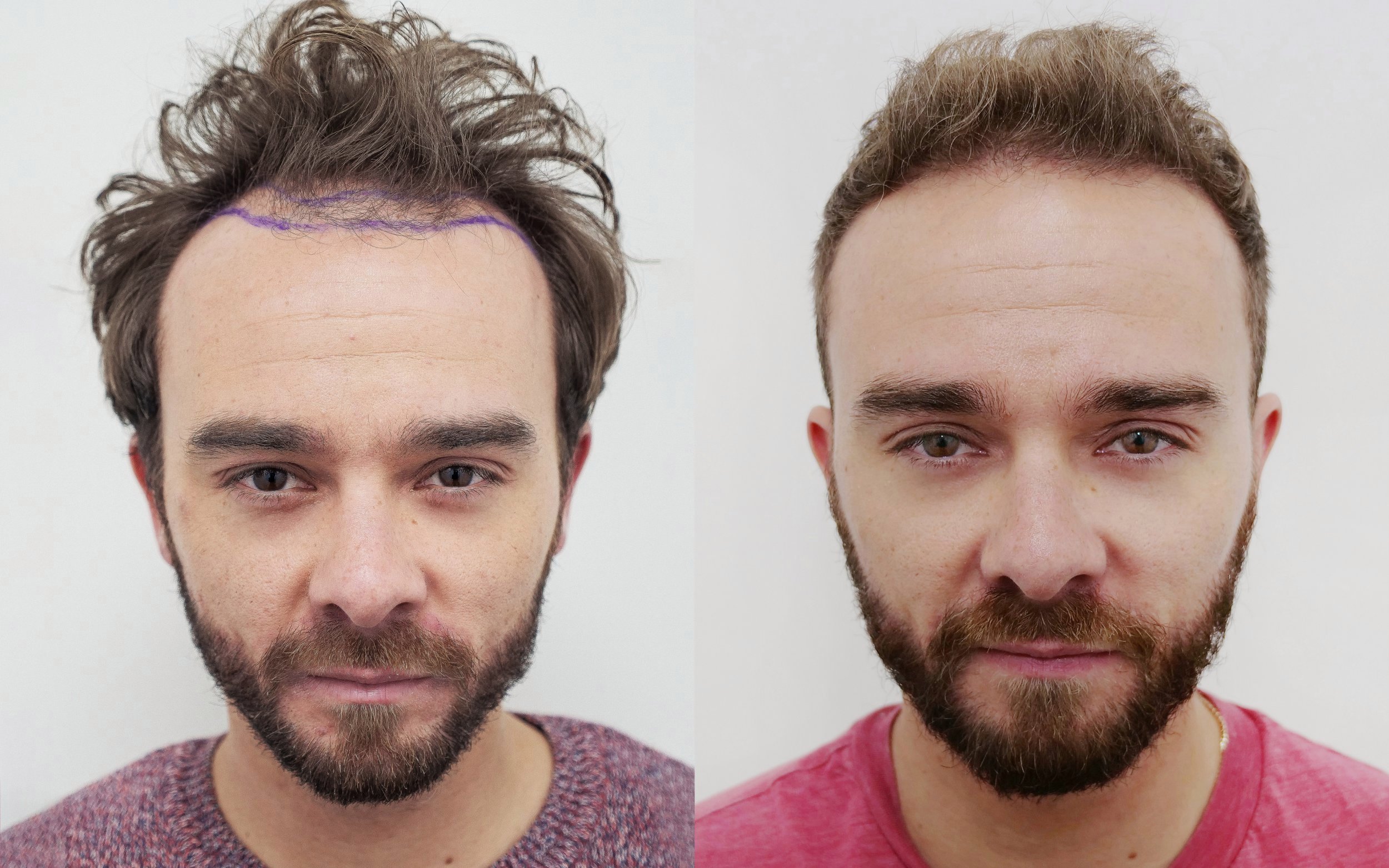 What are the surprising benefits of Bollywood hair transplant?