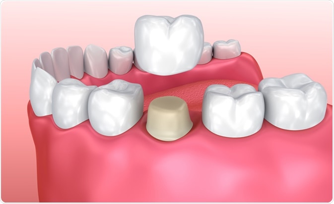 Understanding Dental Crowns: How They Work