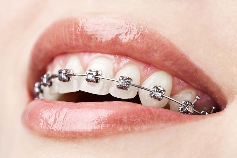 How Much Are Braces