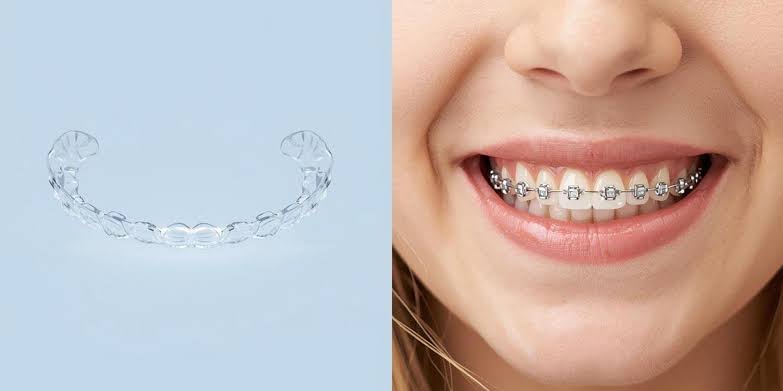 How Much Are Braces